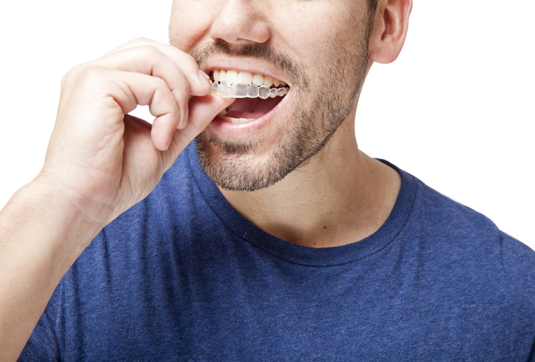 invisalign in west edmonton